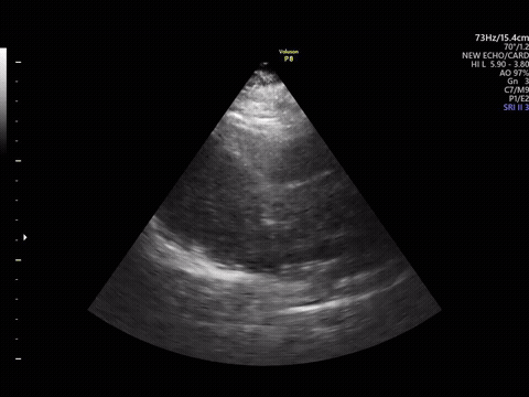 A looping echocardiogram clip showing the characteristic grainy speckle texture flickering across the entire ultrasound sector frame by frame.